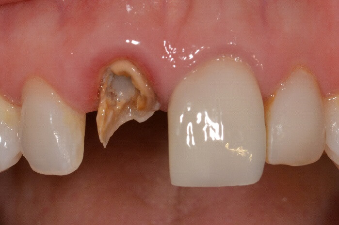 tooth dental implant fractured broken root teeth canal fracture treatment dentist crowns nh replacement happens even