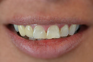 Before treatment