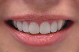 After treatment with dental implants and veneers